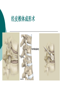 范小春  经皮椎体后凸成形术