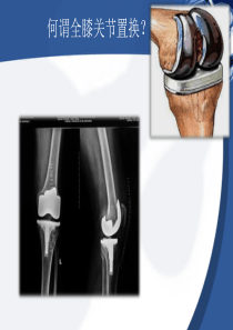 全膝关节置换-ppt课件