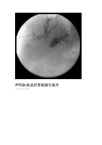 经皮穿刺肝胆管引流术。