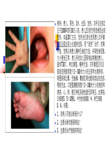 《手足口病》PPT课件