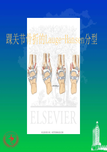 踝关节骨折的Lauge-Hansen分型