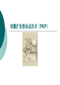 球囊扩张椎体成形PKPppt课件