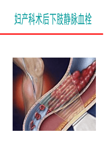 妇科手术后下肢静脉血栓