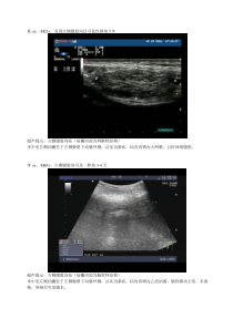 腹股沟疝的超声诊断