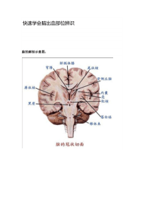 脑出血常见部位