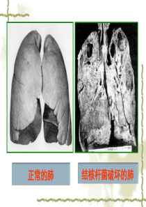 结核病防治知识课件