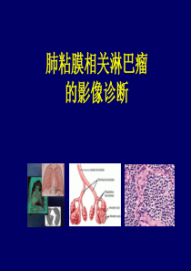 肺粘膜相关淋巴瘤的影像学诊断ppt课件