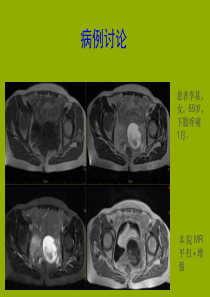 子宫内膜癌病例讨论及MRI分期表现