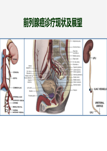 前列腺癌诊疗现状及展望