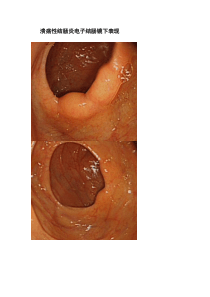 溃疡性结肠炎电子结肠镜下表现
