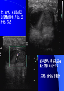 坐骨结节囊肿