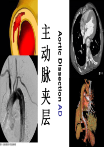 主动脉夹层ppt