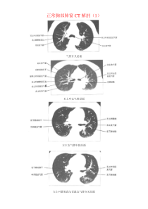 正常胸部CT解剖(肺窗和纵隔窗)