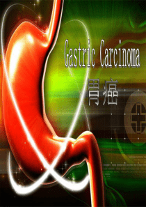 医学英语疾病介绍-Gastric-Carcinoma(胃癌)