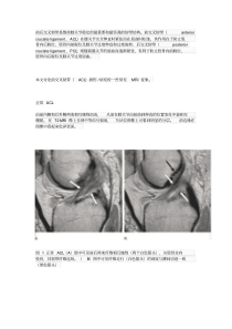 前交叉韧带常见损伤及病变的MRI诊断